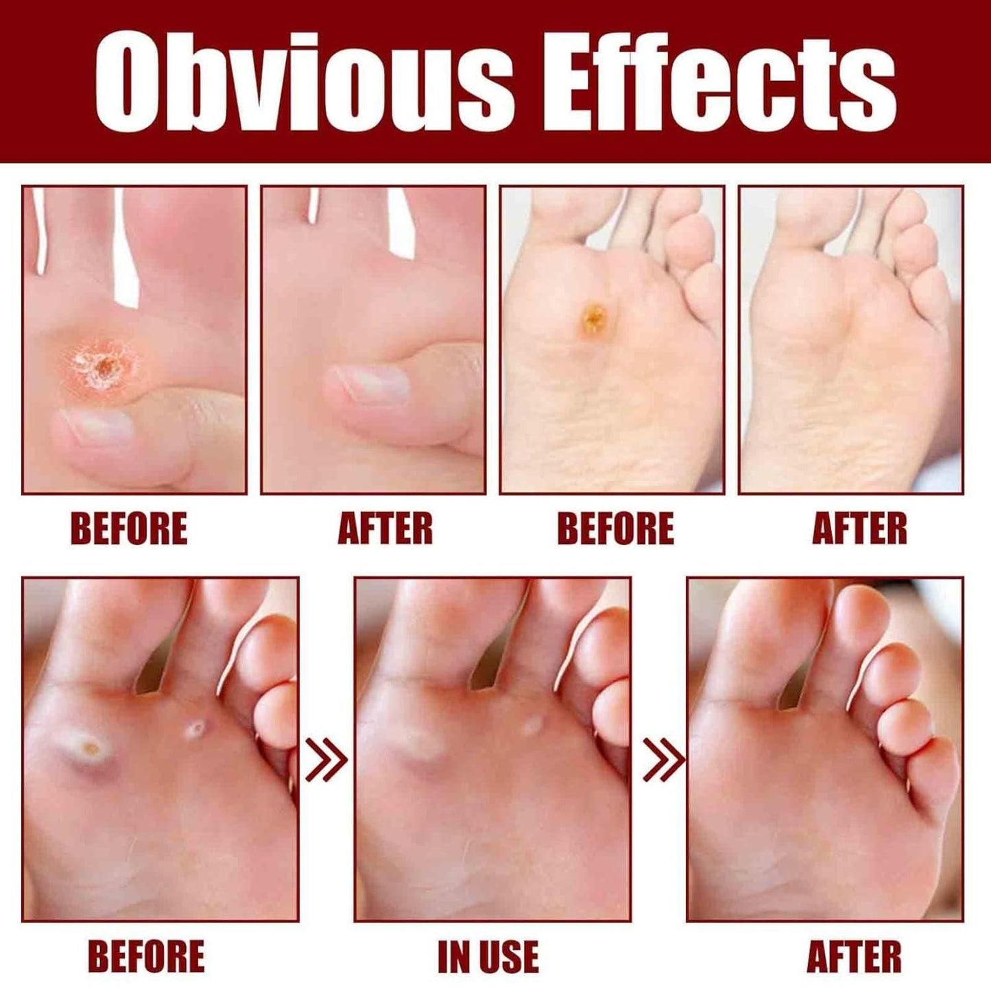 CORN REMOVAL FOOT SERUM